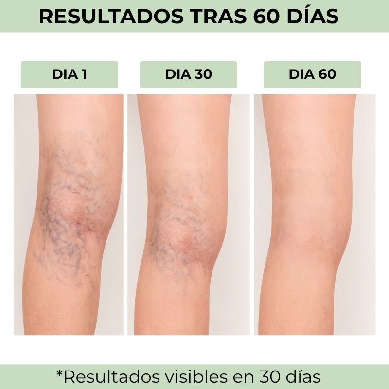 Natuvar® - Parches para las varices