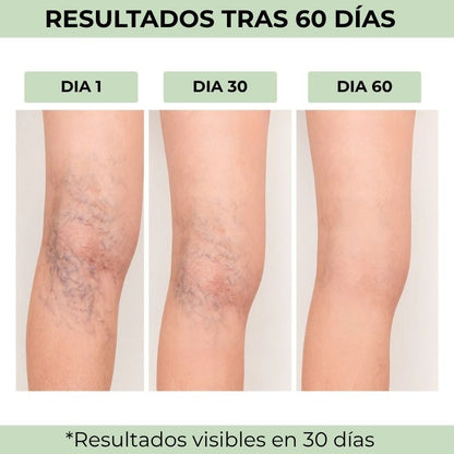 Natuvar® - Parches para las varices